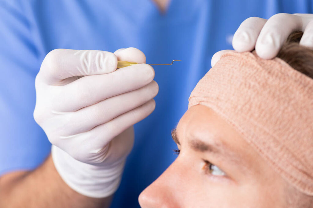 Lekarz tworzący miejsca biorcze w skórze głowy pacjenta w trakcie zabiegu przeszczepu włosów FUE